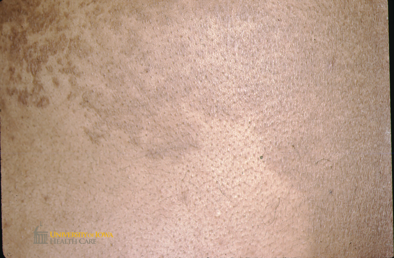 Hyperpigmented slightly scaly papules coalescing into a plaque on the abdomen. (click images for higher resolution).